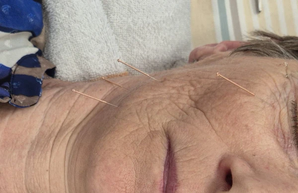Cosmetische acupunctuur Cimbaalstraat Nijmegen