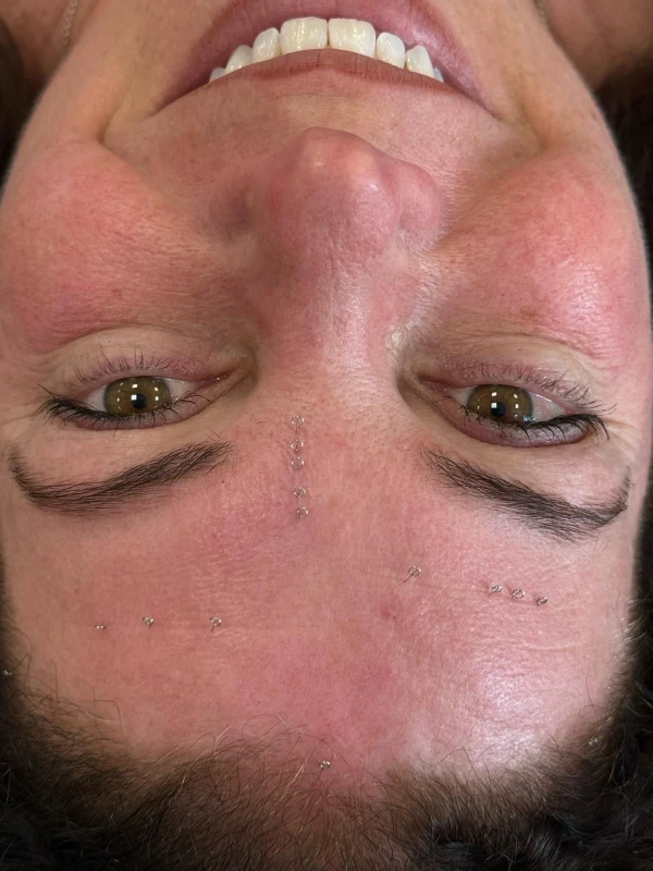 Cosmetische acupunctuur Cimbaalstraat Nijmegen