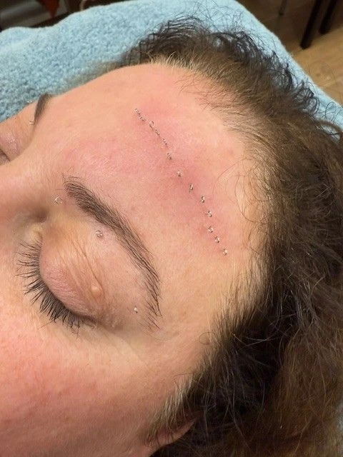 Cosmetische acupunctuur wenkbrauwlift Cimbaalstraat Nijmegen