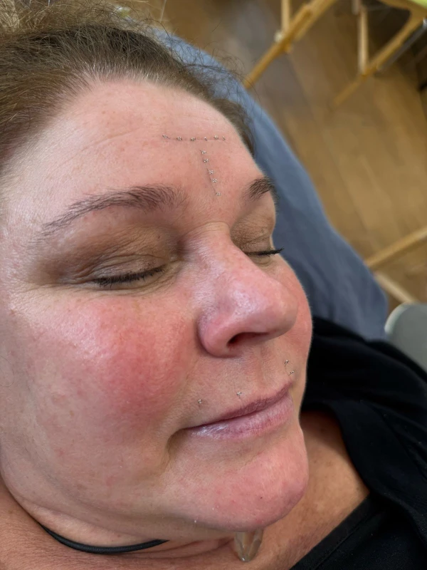 Cosmetische acupunctuur Cimbaalstraat Nijmegen
