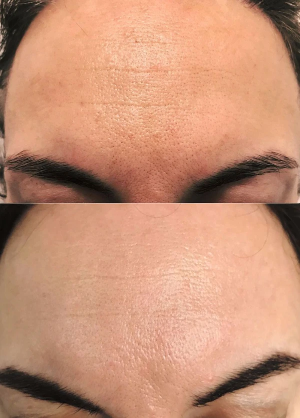 Advanced Bio Peel Therapy Nijmegen
